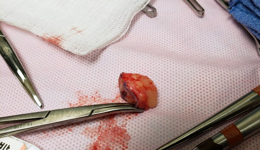 Jenifer DeLemont, Cancer, Jenifer DeLemont's Tumor, Tumor